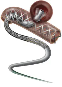 Микрокатетер Terumo  Headway17x  